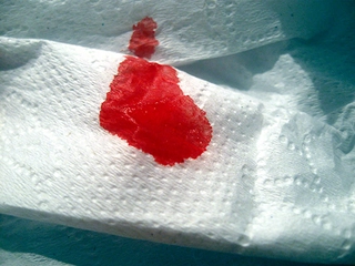 Kırmızı Kusmak Belirtileri ve Tedavisi Kırmızı Kusmak Belirtileri ve Tedavisi